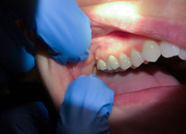 Best Emergency Dental Extractions in Oak Trail Shores, TX